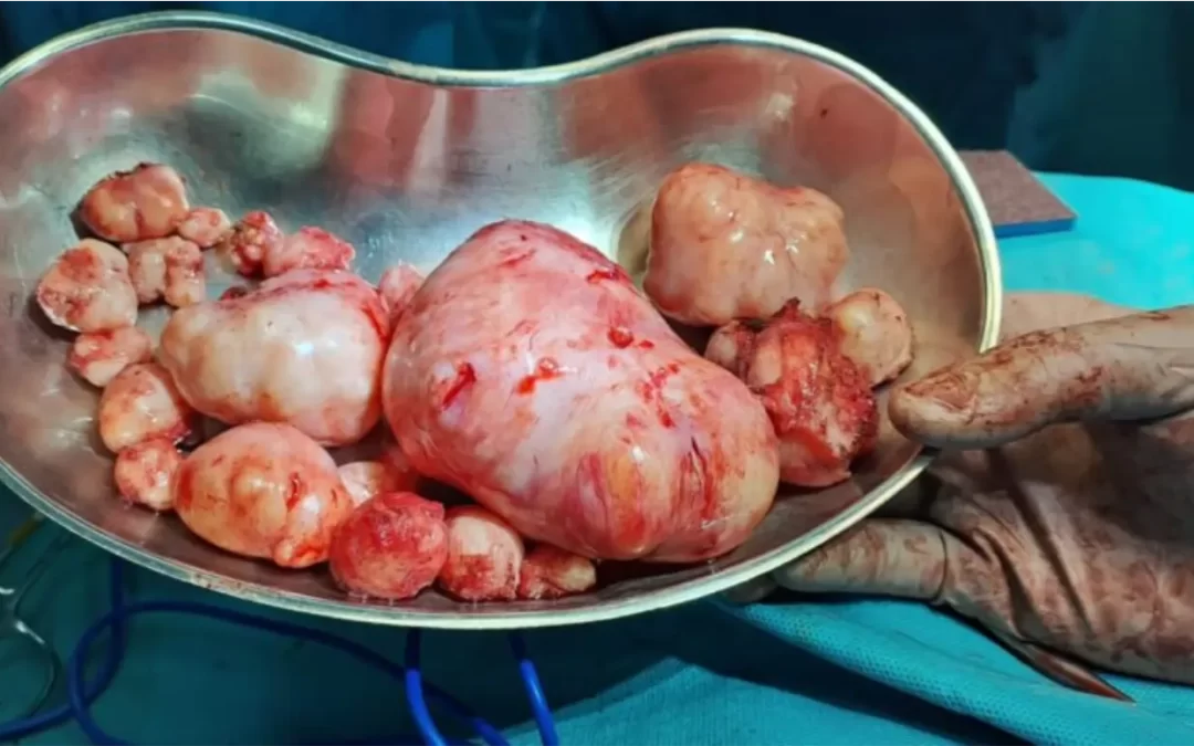 Miomas uterinos: qué son, síntomas, diagnóstico y tratamiento